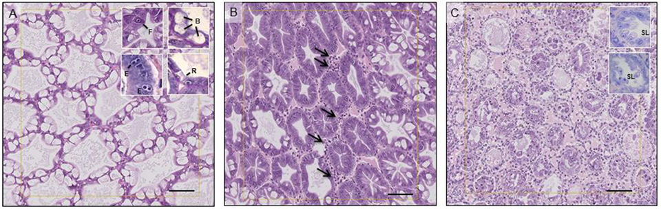 Fig. 1: Imágenes de hepatopáncreas de L. vannamei que muestran las variaciones morfológicas del tejido características de la patología AHPND. (A) Histomorfología del camarón no infectado que muestra túbulos de hepatopáncreas normales (HP) con distintas células R- (resorción), B- (tipo ampolla), F- (fibrilar) y E (embrionarias). (B) Histopatología de HP, que muestra lesiones típicas de AHPND: degeneración progresiva de las células epiteliales de túbulos del HP, acompañada de una disminución de las células R, B y F seguida de una marcada reducción de la actividad mitótica en células y E inter-tubulares con infiltración hemocítica (flechas); (C) desprendimiento necrótico (SL) de las células epiteliales del túbulo HP en los lúmenes y los restos de túbulos HP rodeados por infiltrados hemocíticos. Este último no tiene células R, B o F y algunas células epiteliales presentan una cariargalia prominente (núcleos agrandados). Las secciones histológicas se tiñeron con H &amp; E. Barras de escala = 150 μm.